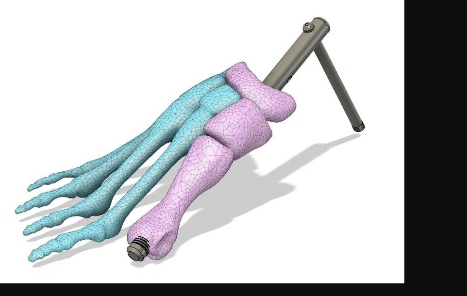 CAD model of foot and ankle skeletal anatomy with a fixture